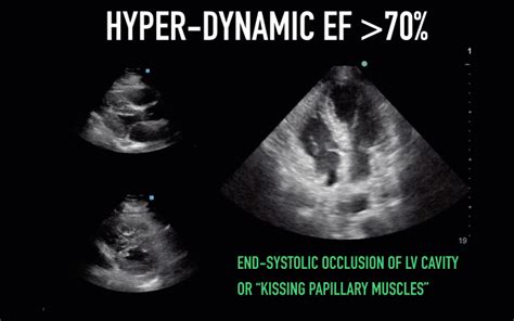 sf to lv|echocardiography lv function.